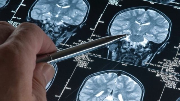 Ручка, що вказує на МРТ-знімок головного мозку